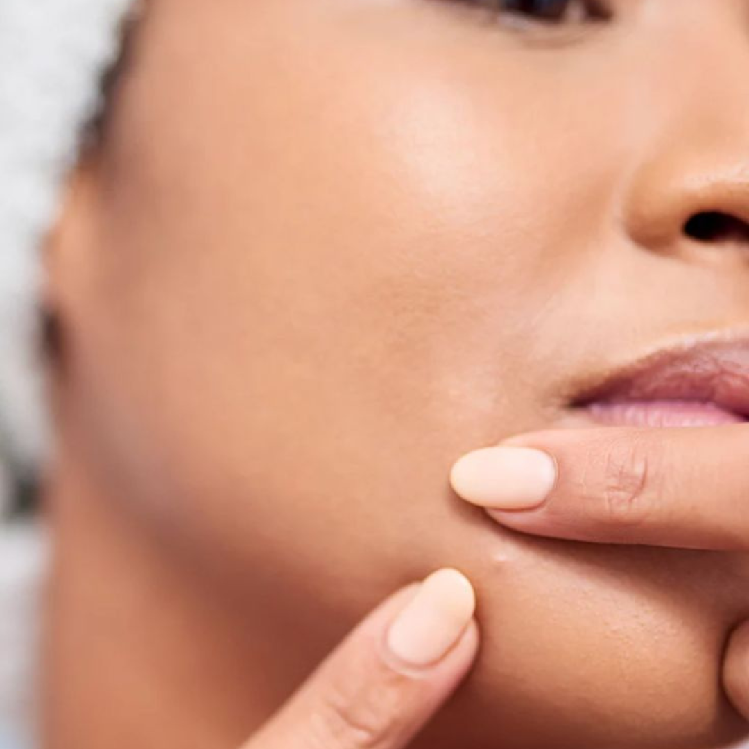 Acné adulto: por qué aparece y cómo eliminarlo (la guía definitiva)