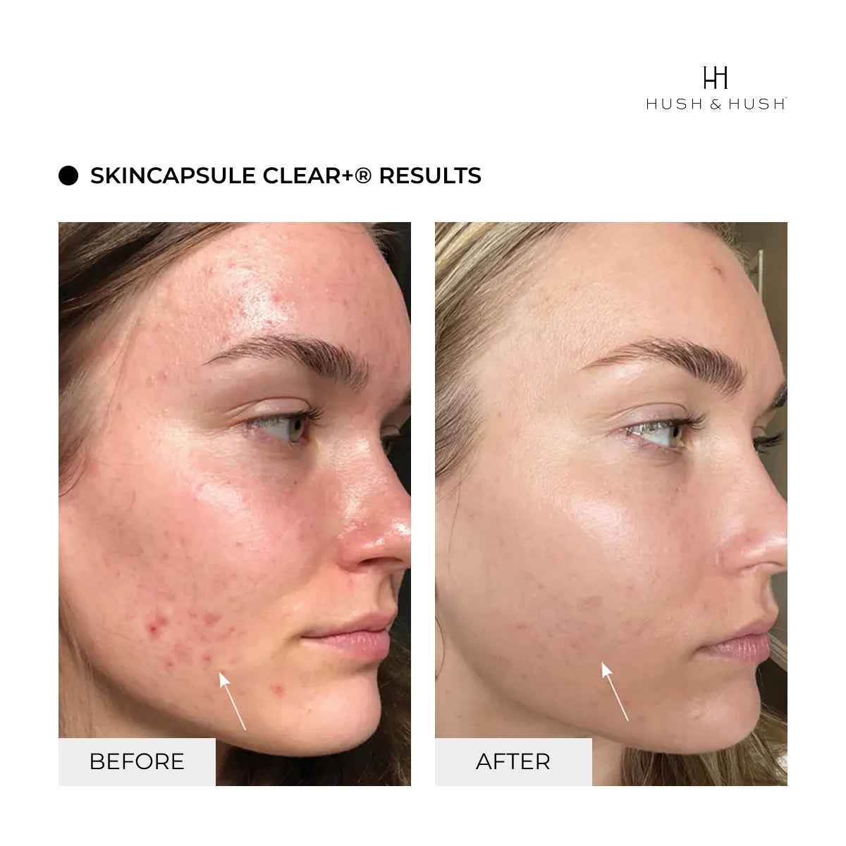 Suplemento Antiacné · SkinCapsule CLEAR+