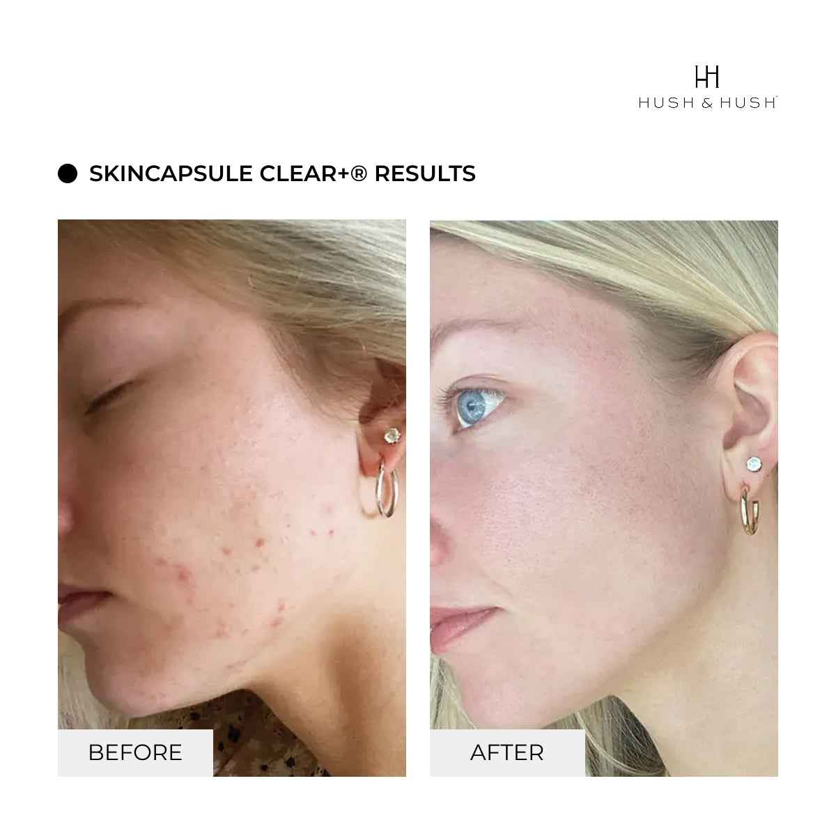 Suplemento Antiacné · SkinCapsule CLEAR+